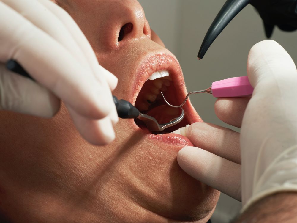 Förebygg större ingrepp med tandhygienist i Odenplan